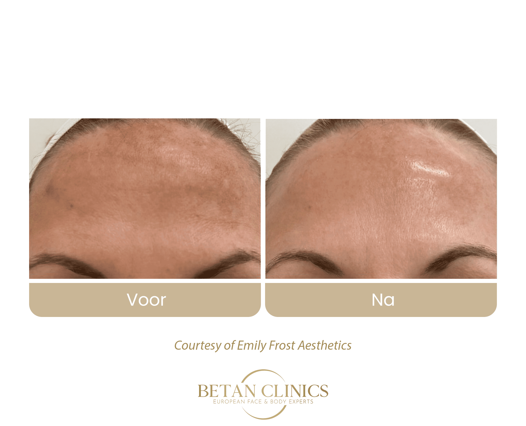 virtuerf rf microneedling gezichtsvlekken behandeling betan clinics