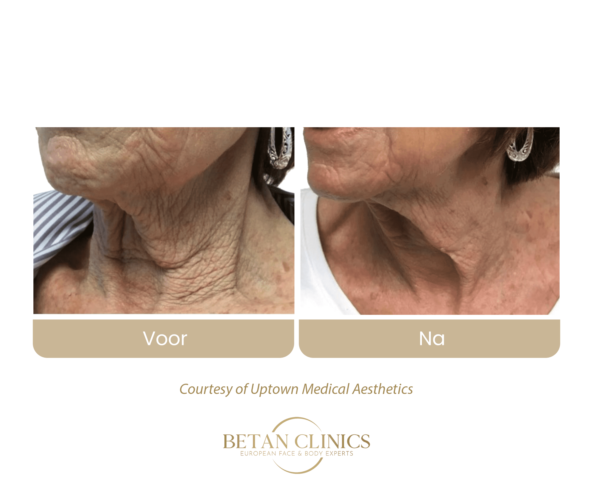 virtuerf rf microneedling hals decolleté behandeling betan clinics