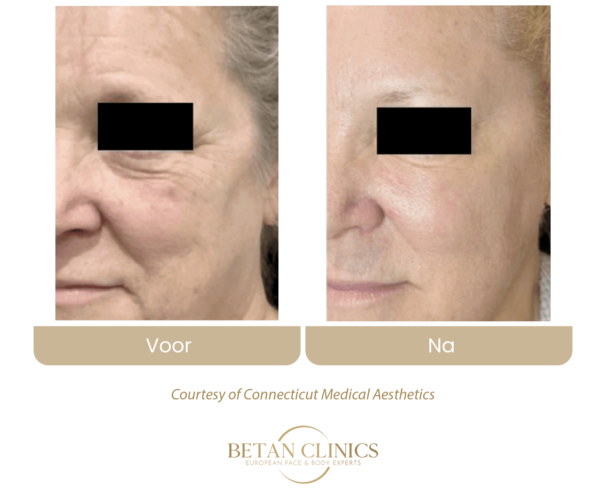 virtuerf rf microneedling rimpels onder ogen wallen behandeling betan clinics