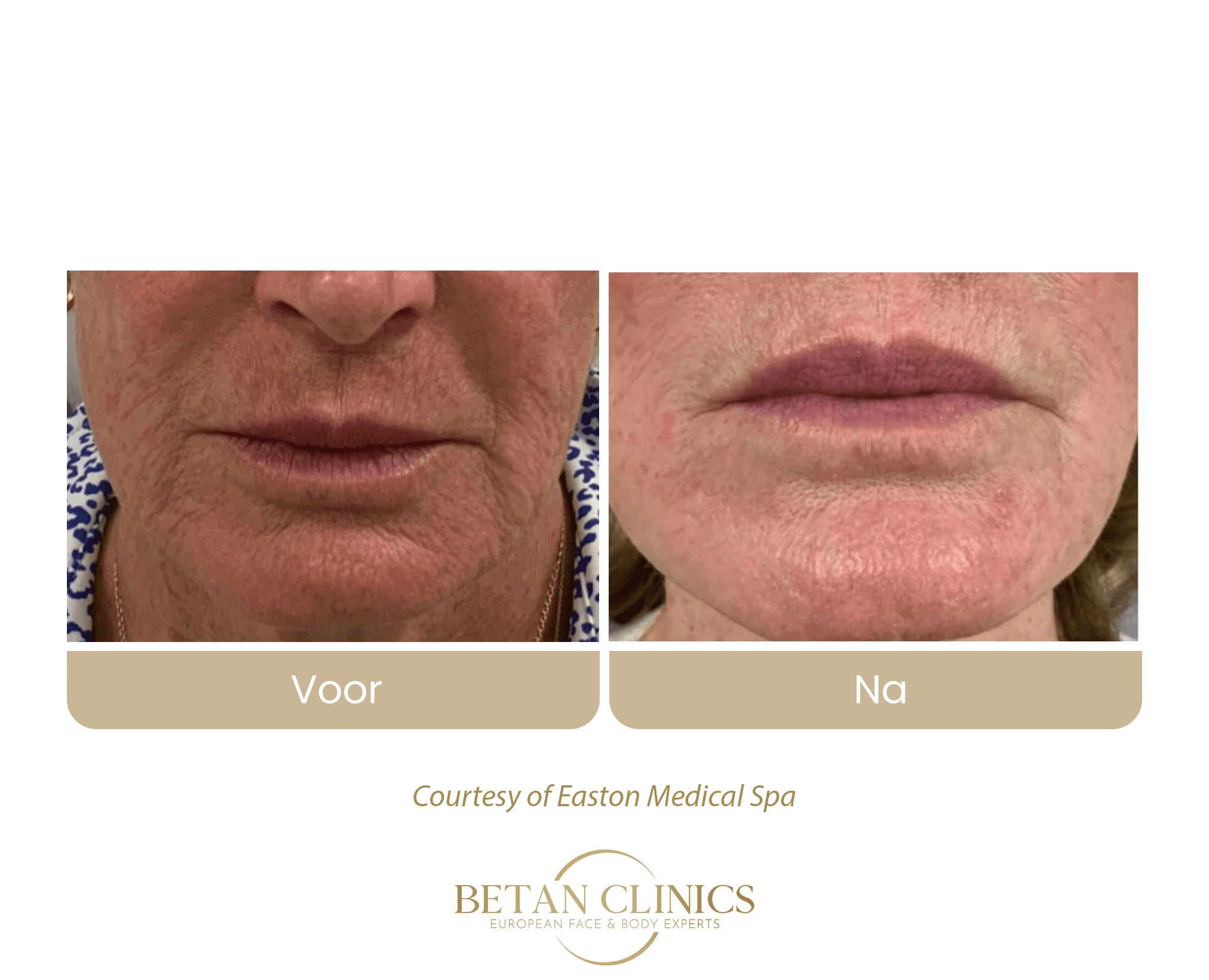 virtuerf rf microneedling rimpels rondom mond rokerslijnen behandeling betan clinics