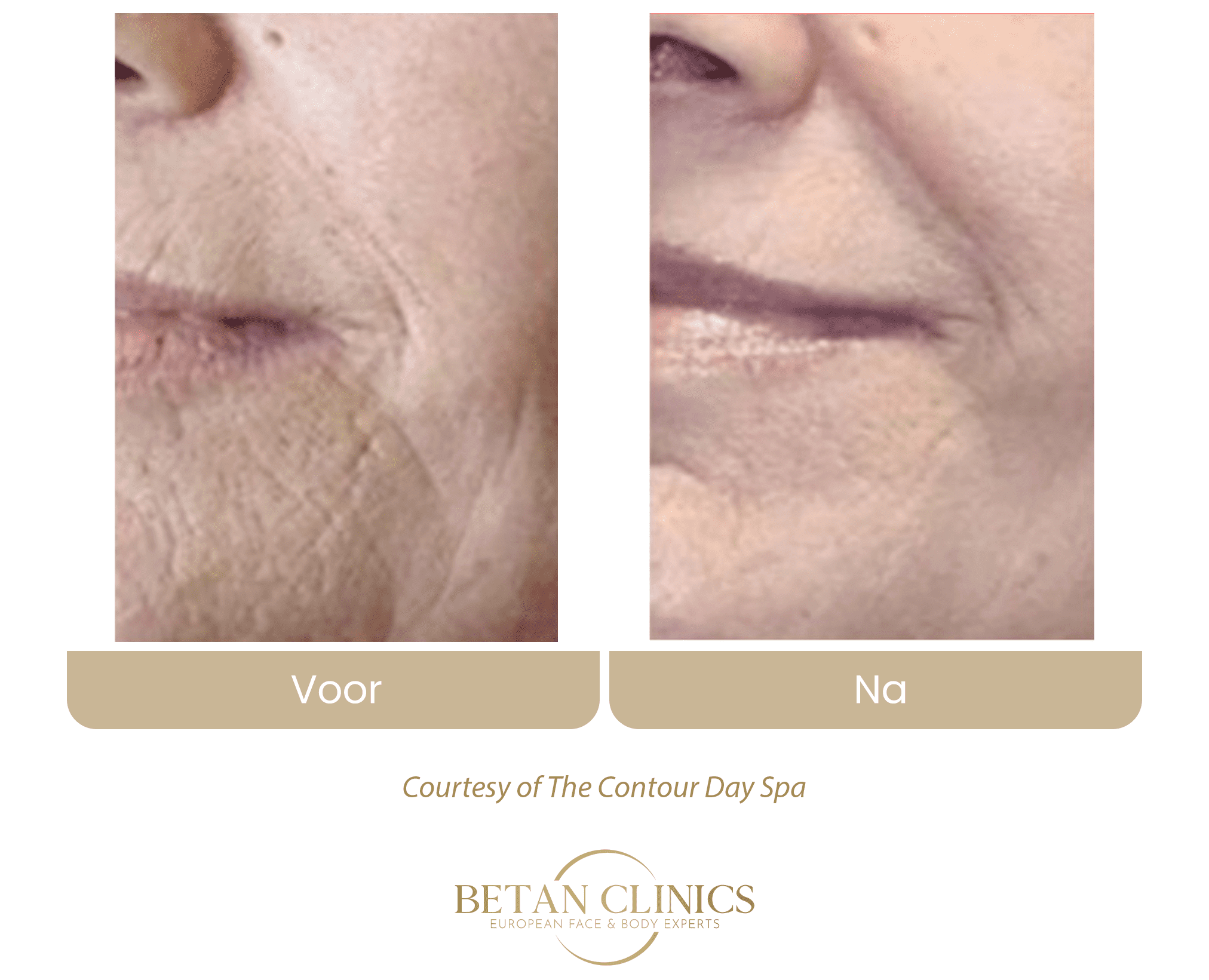 virtuerf rf microneedling rimpels wang marionetlijnen behandeling betan clinics