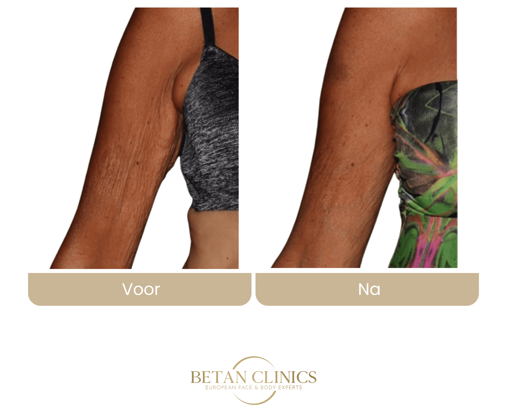 virtuerf rf microneedling slappe huid arm lichaam betan clinics